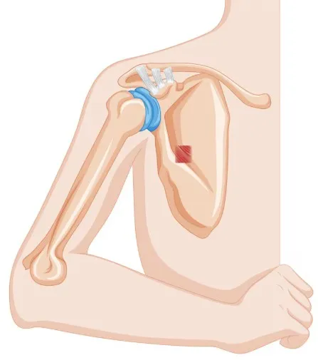 Humerus fracture diagnosis, treatment, and surgical care